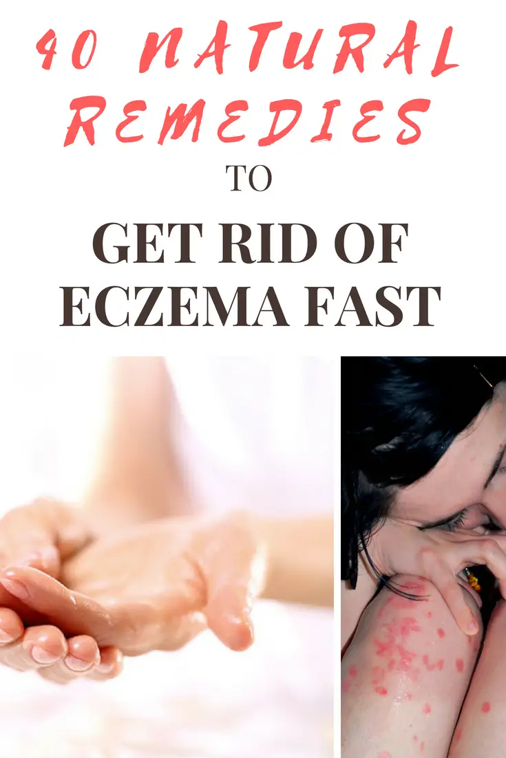40 Natural Eczema Treatments &  Remedies